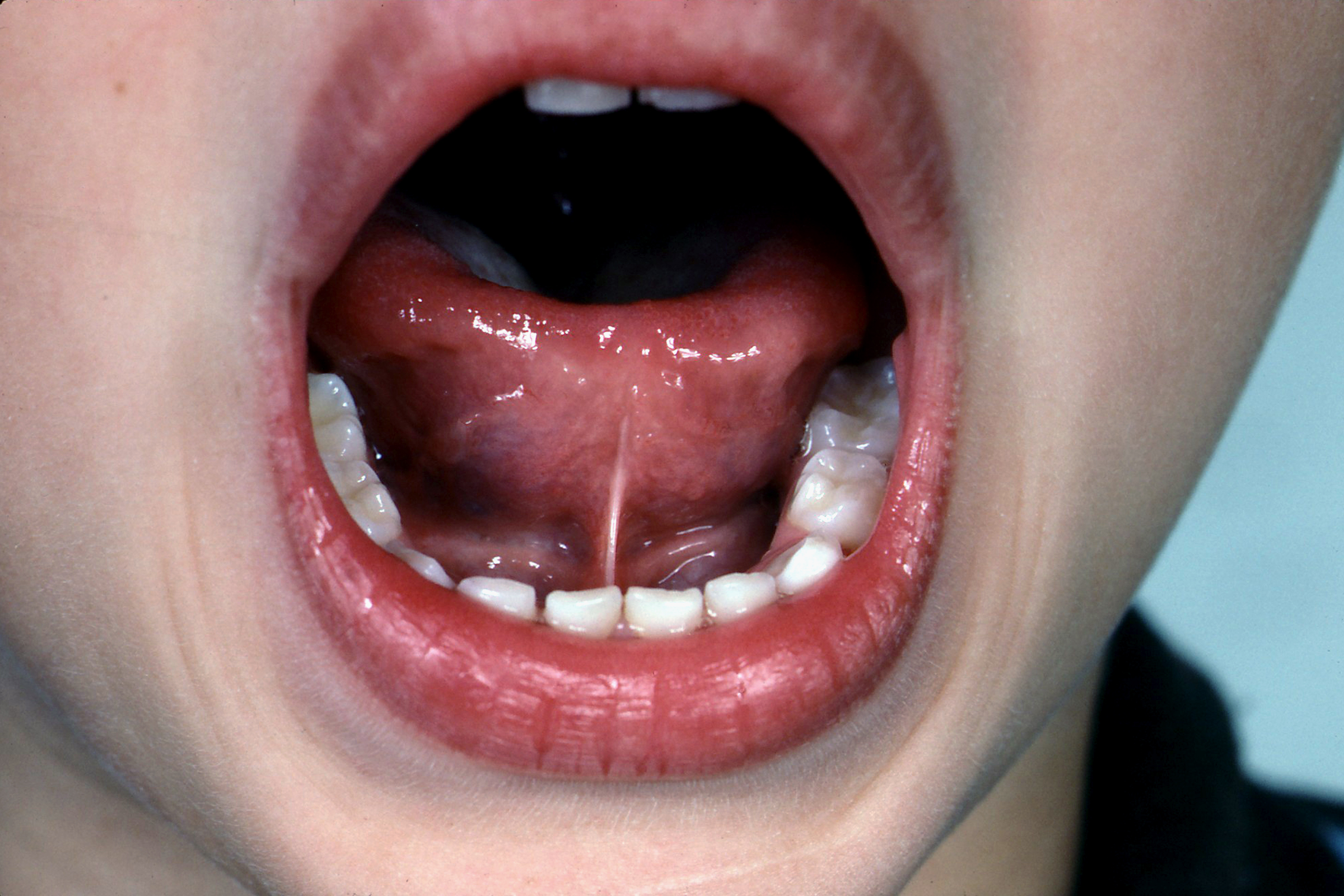Tongue Nipples 30