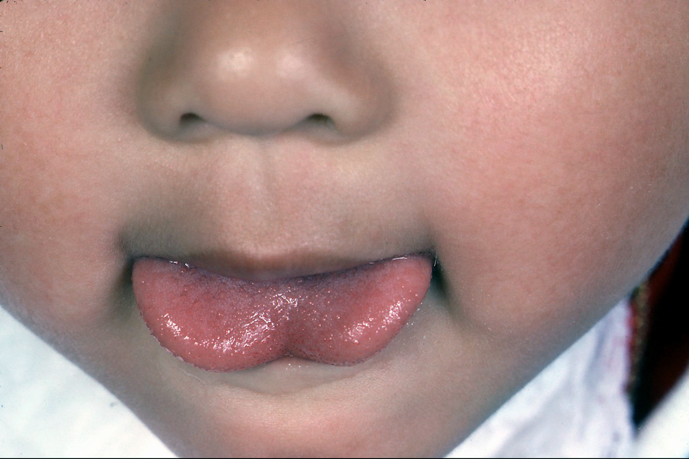 正常婴儿舌系带图片（大西几）-幼儿百科-魔术铺