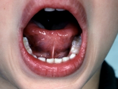 Cup shaped tongue when attempting intra-oral elevation.