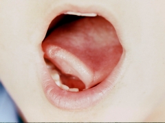 Attempting lateral lick - 1/2 tongue lifts showing frenum and a lesion.