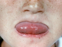 Bulky tongue in protrusion fills oral space, held tightly by lips.