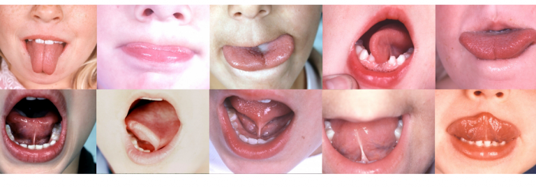 tongue-tie-information-for-parents-and-practitioners-tongue-tie